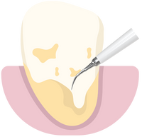 Removes built-up plaque and tartar fast